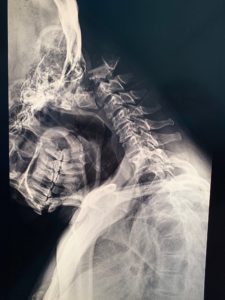 x-ray-photo-before-procedure