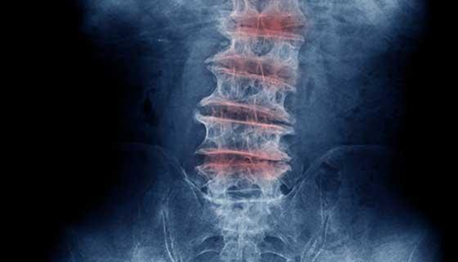 x-ray-image-showing-multilevel-degenerative-changes-in-the-lumbar-spine