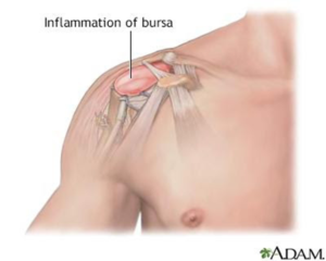 inflammation-of-bursa man-shoulder-having-inflammation-of-bursa
