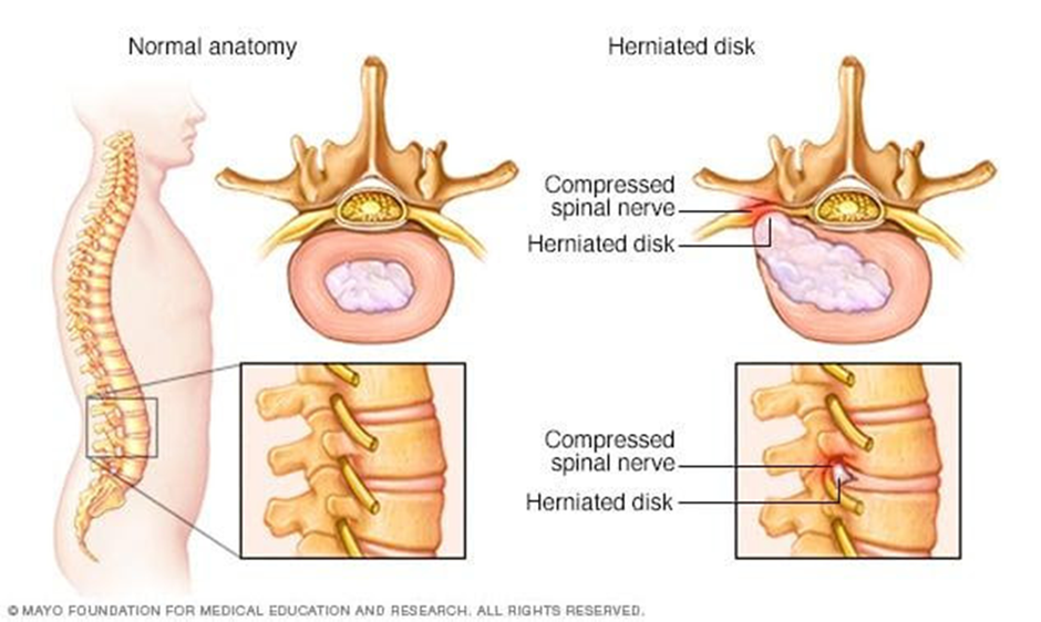 herniated-disc-spinal-nerve-anatomy