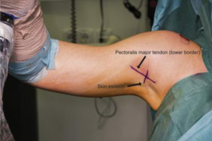 shoulder-having-sub-pectoral-biceps-tenodesis