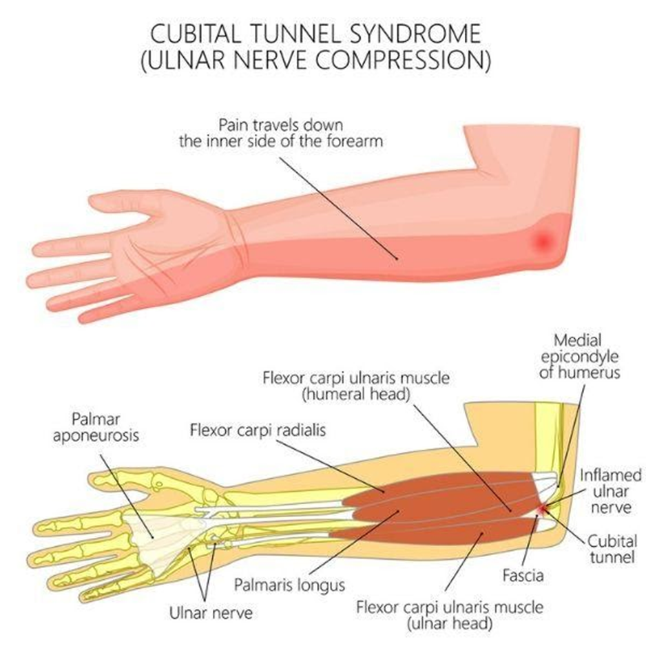 ulnar-nerve-compression-cubital-tunnel-release-syndrome-diagram