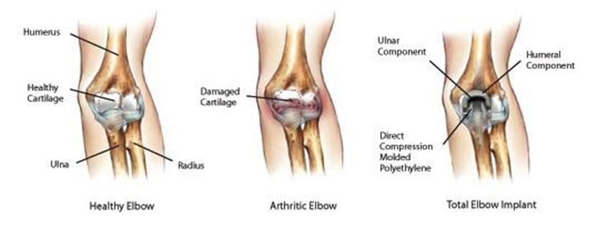 elbow-arthritis-anatomy