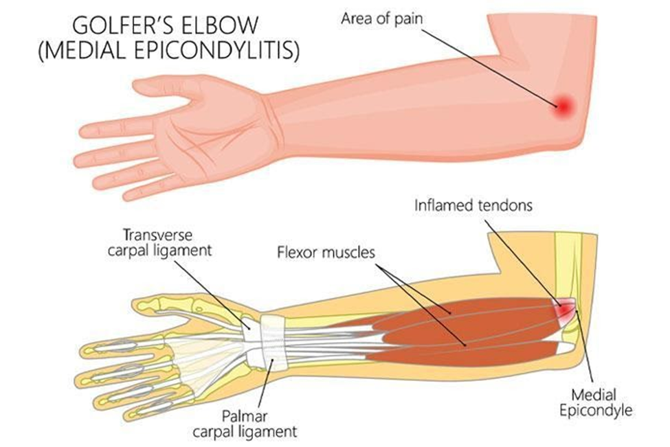 causes-of-golfers-elbow-medial-epicondylitis