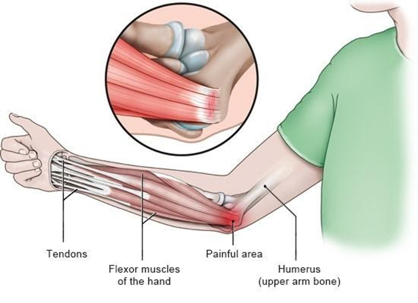symptoms-of-golfers-elbow