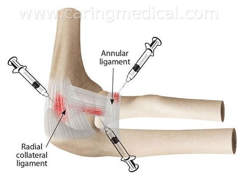 prevention-of-hand-elbow-treatment-injection