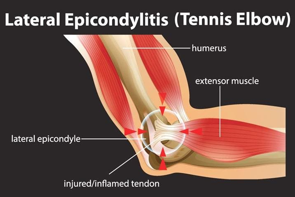 lateral-epicondylitis-tennis-elbow-surgery-anatomy