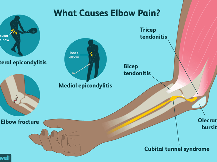 causes-of-tennis-elbow-pain