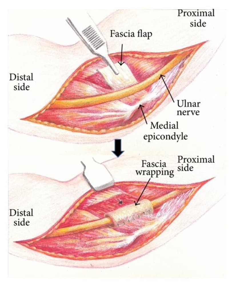 diagram-of-ulnar-nerve-transposition