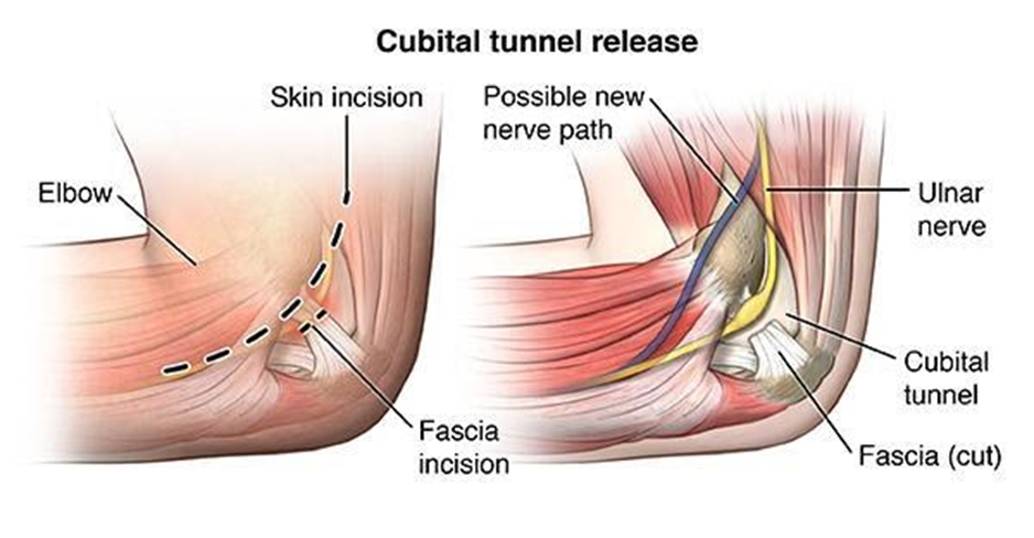 cubital-tunnel-release-anatomy