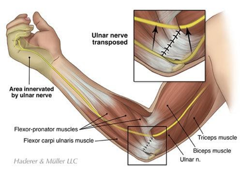 ulnar-nerve-transposition-treatment-diagram