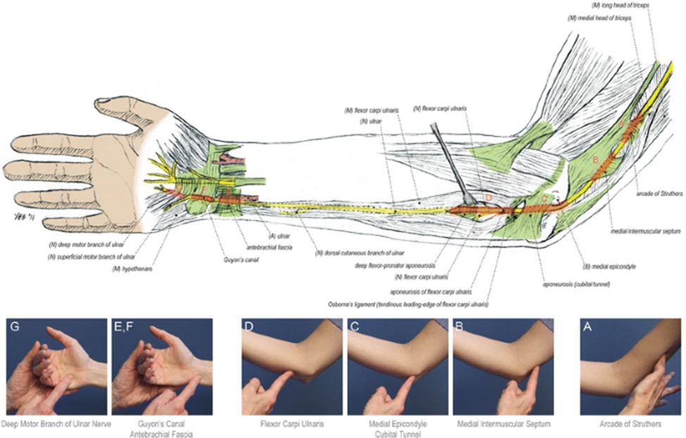 ulnar-nerve-transposition-diagnosis-diagram