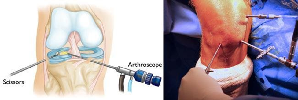 arthroscopy-knee-surgery-diagram