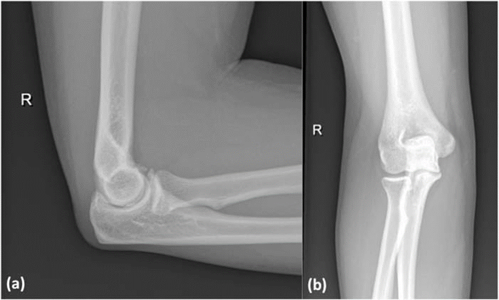 diagnosis-of-elbow-arthroscopy-diagram