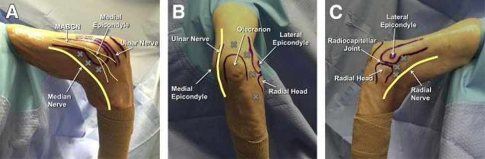 treatment-of-elbow-arthroscopy-diagram
