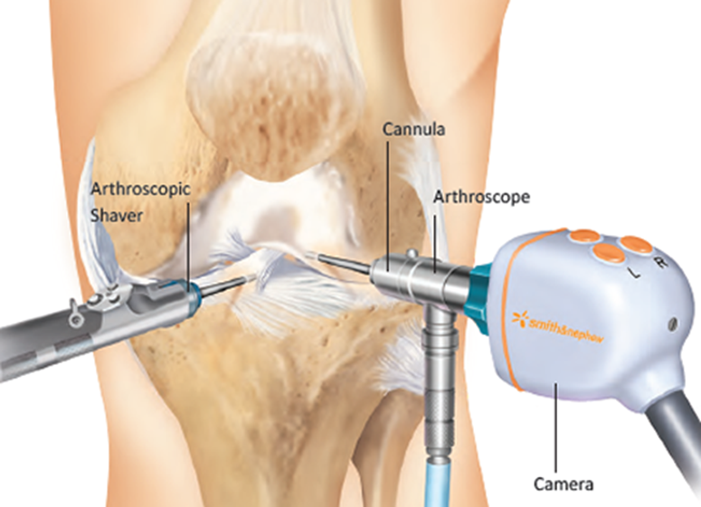 arthroscopic-knee-surgery-treatment