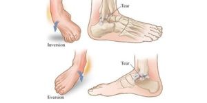 Don't Spiral into an Ankle Sprain — Valley Stream Podiatry