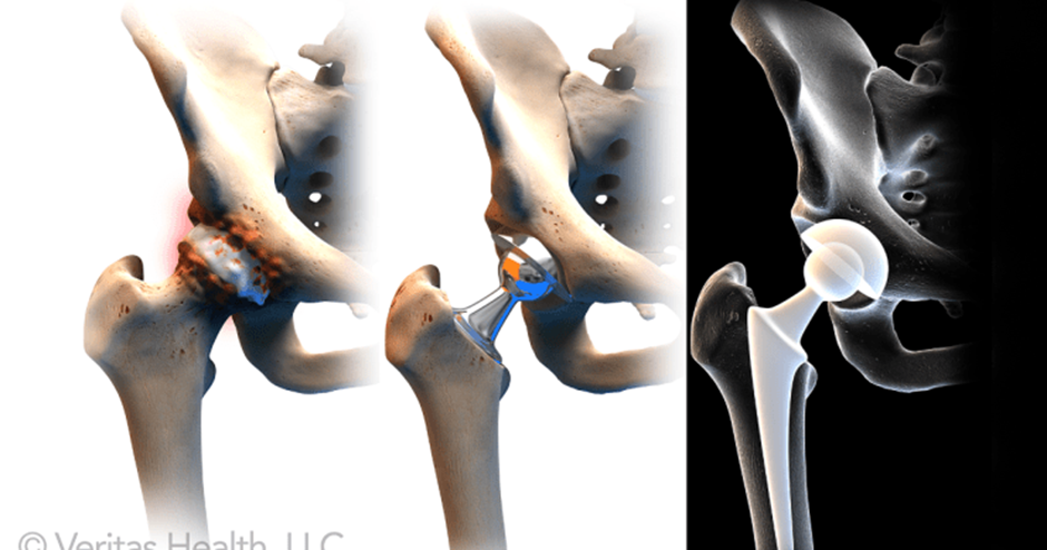 Total Hip Replacement - Anterior Approach