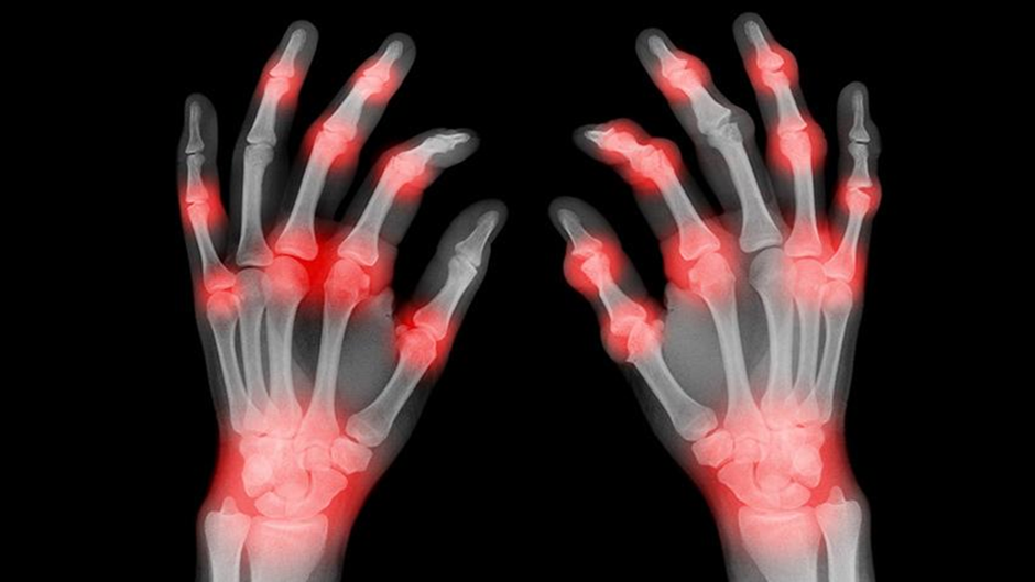 arthritis-in-hand - sforzo