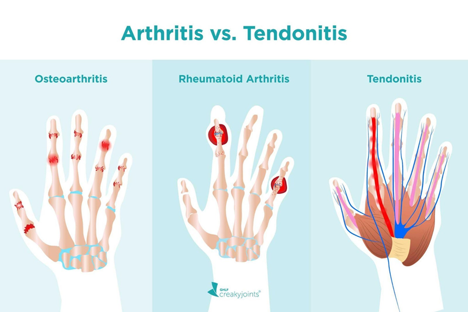 arthritis-vs-tendonitis-sforzo