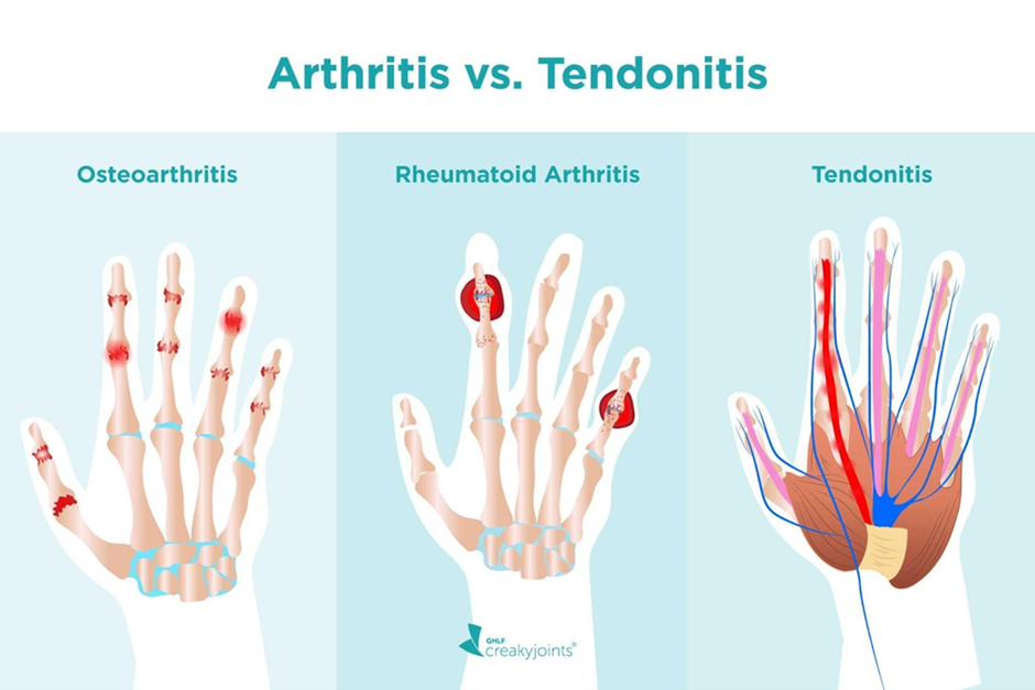 DIP Joint Osteoarthritis: How to Treat this Common Form of Arthritis