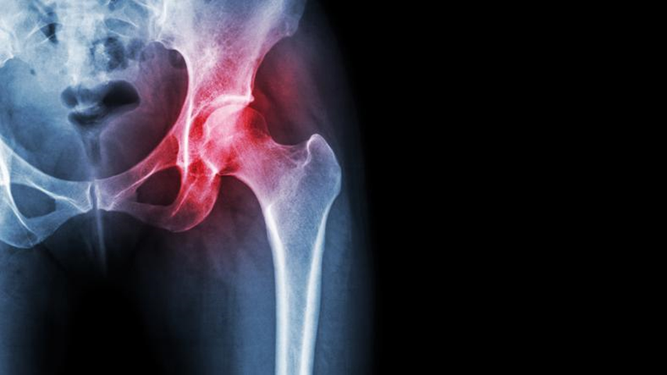 hip-dislocation-after-total-hip-replacement-surgery-diagnosis