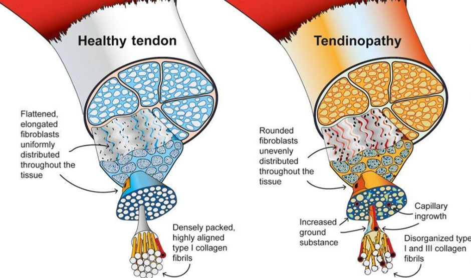 elbow-tendonitis-diagram