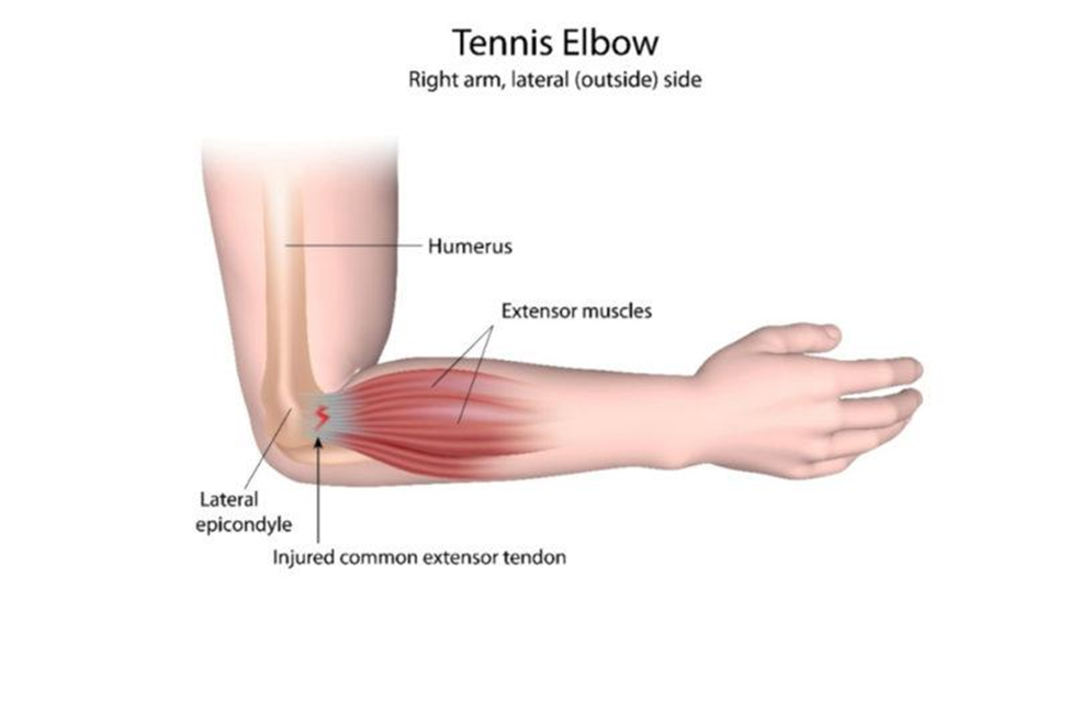 prp-tennis-elbow-pain