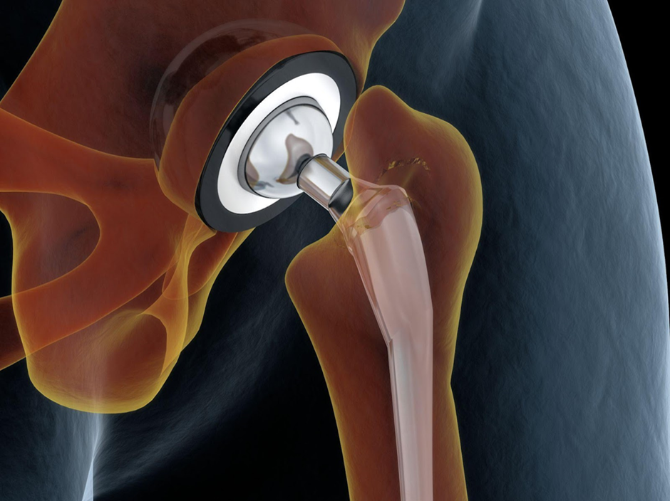 Total Hip Replacement - Anterior Approach