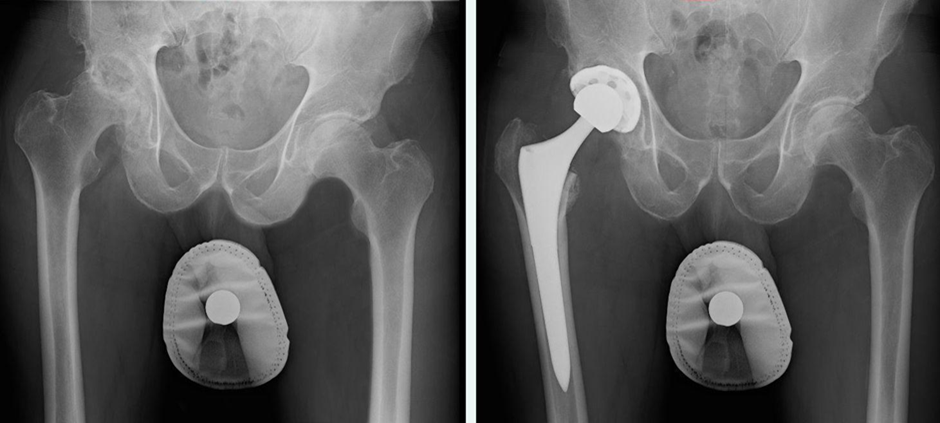 total-hip-replacement-anterior-approach-diagnosis