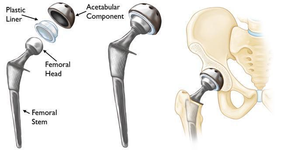 total-hip-replacement-anterior-approach-treatment