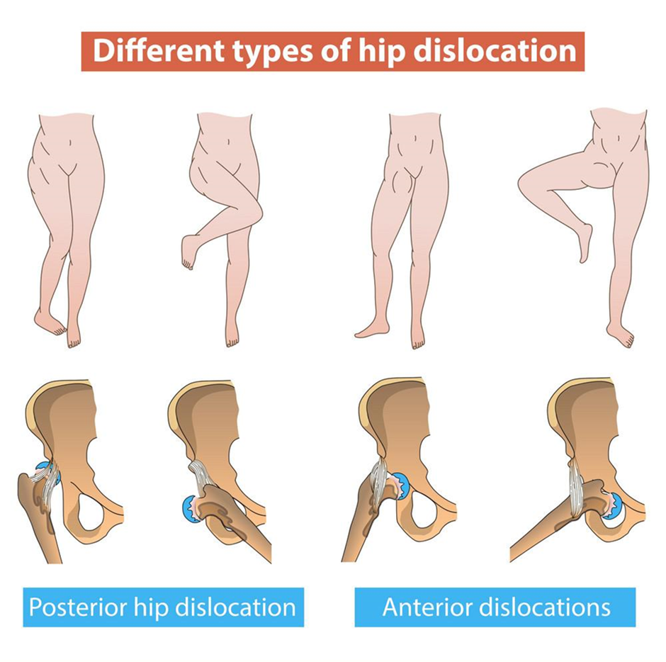 different-types-of-hip-dislocation
