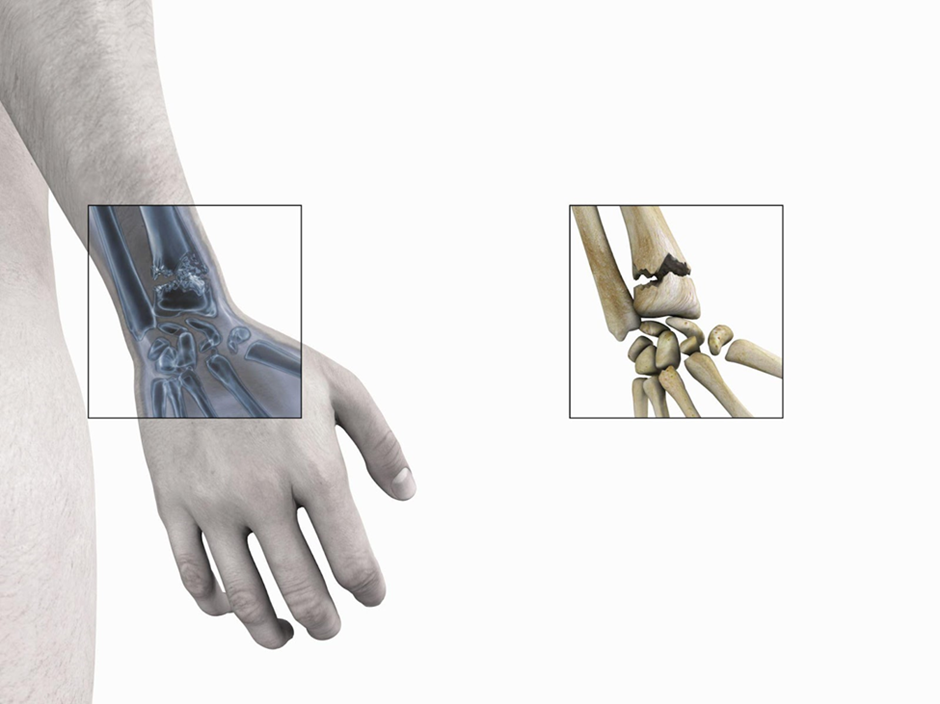 How Hand Fractures are Diagnosed and Treated