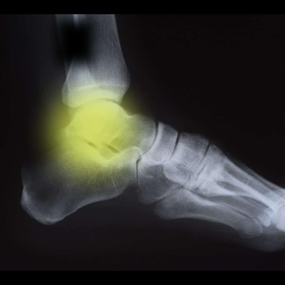 symptoms-of-arthritis-x-ray-image