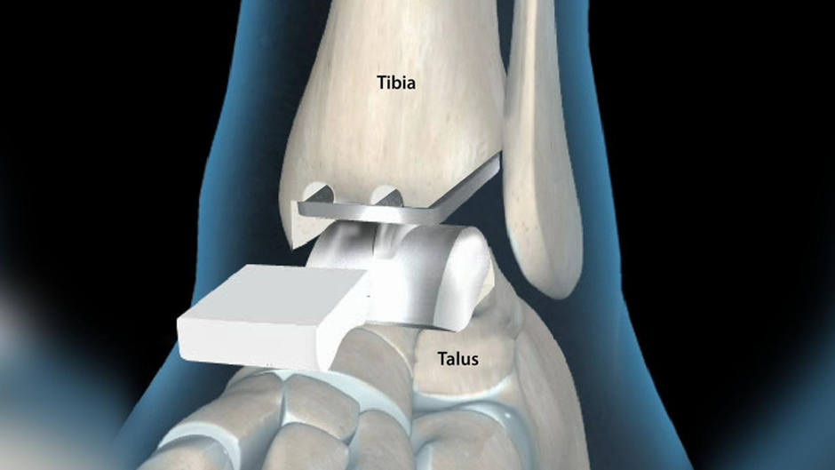 total-ankle-replacement-treatment-animation-image