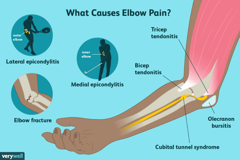 Treat Elbow Pain & Arthritis with Professional Sforzo Dillingham