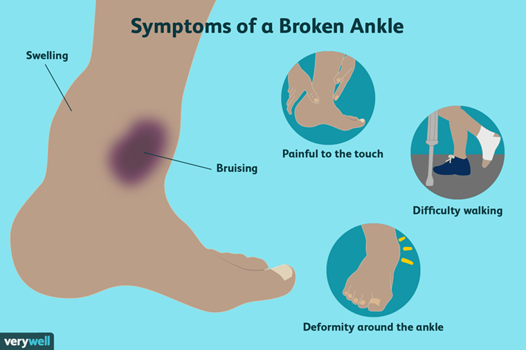 Ankle Fracture Surgery Procedure, Recovery Sforzo Dillingham