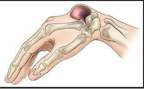 Ganglion Cysts