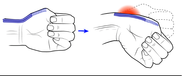 Treat De Quervain’s Tenosynovitis