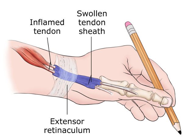 DeQuervain’s Tenosynovitis