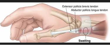 Fluid Retention