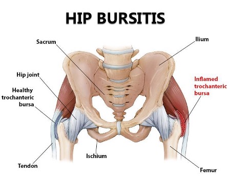 Trochanteric Hip Bursitis  Spine & Orthopedic Center