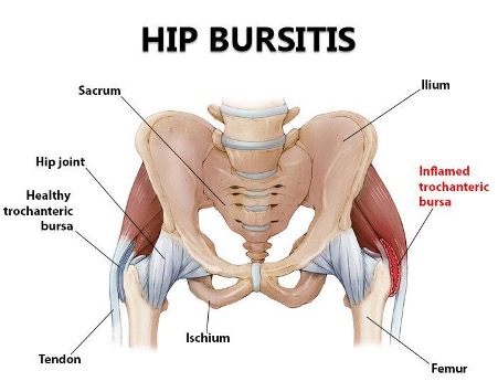 Trochanteric Bursitis, Hip Specialist