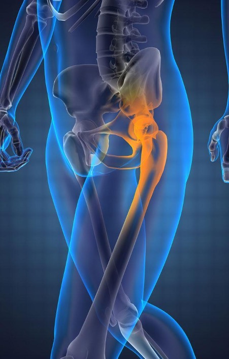 Trochanteric Bursitis, Hip Bursitis, Orthopedic Hip Specialist