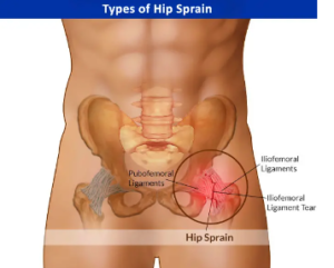 Hip Strains 