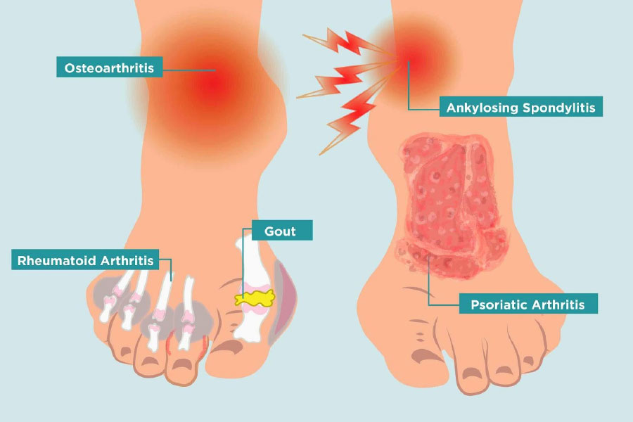 osteoarthritis diagram